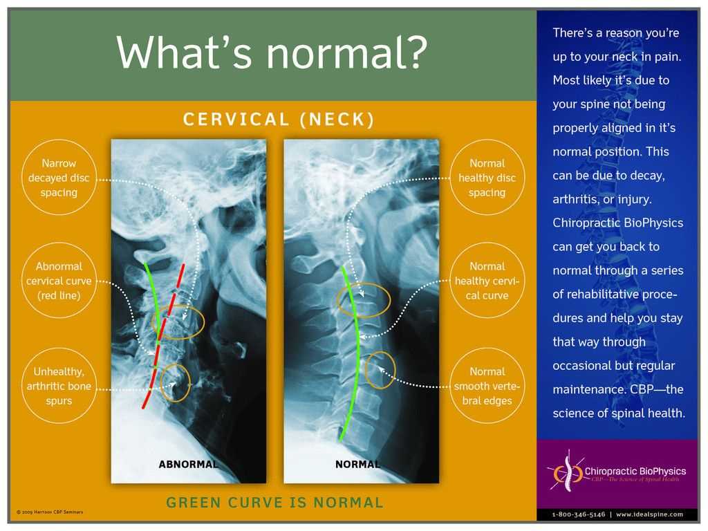 Normal Vs. Abnormal Cervical X Ray – Chiropractic Biophysics Inside Chiropractic X Ray Report Template